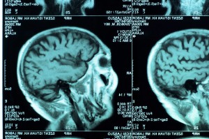 The brain